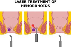 Technique du laser pour soigner les hémorroïdes